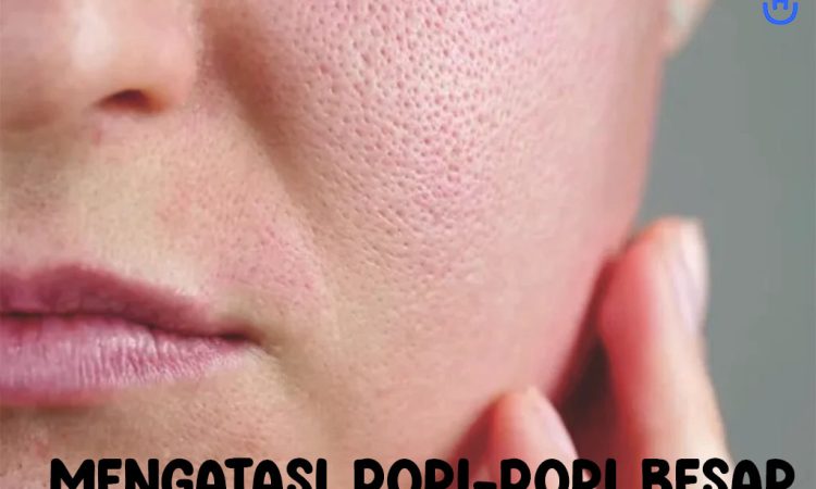 Mengatasi Pori-pori Besar